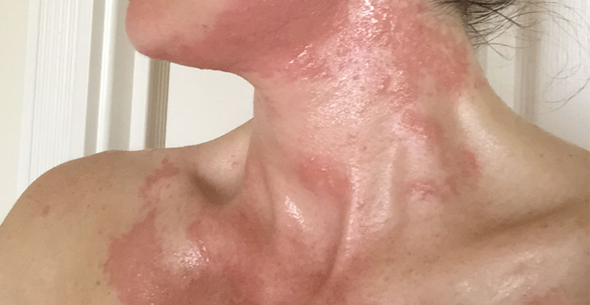 Jak zklidnit alergickou reakci na obličeji?